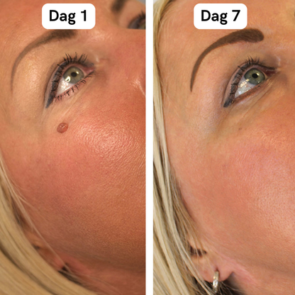 DermaSkin Pro™ - Vaarwel Huid Tags