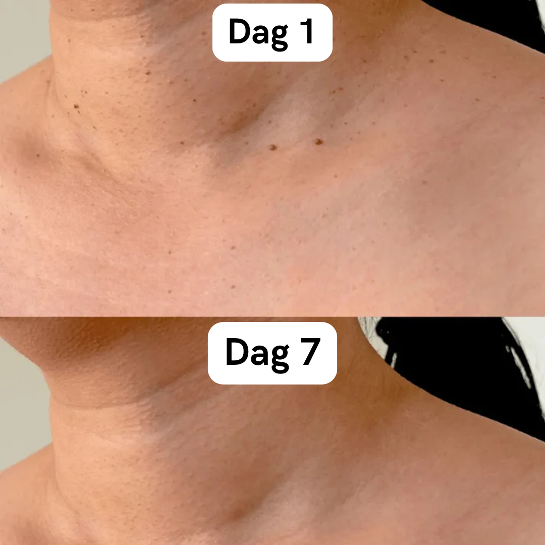 DermaSkin Pro™ - Vaarwel Huid Tags