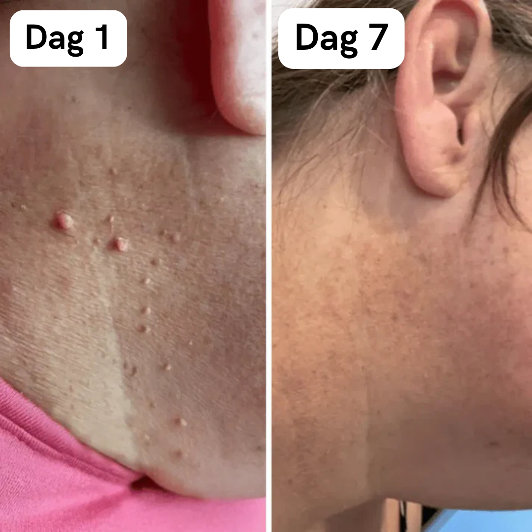 DermaSkin Pro™ - Vaarwel Huid Tags