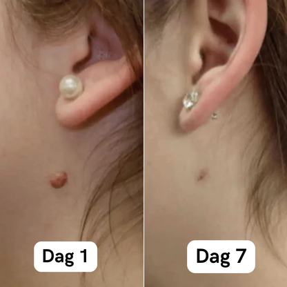 DermaSkin Pro™ - Vaarwel Huid Tags