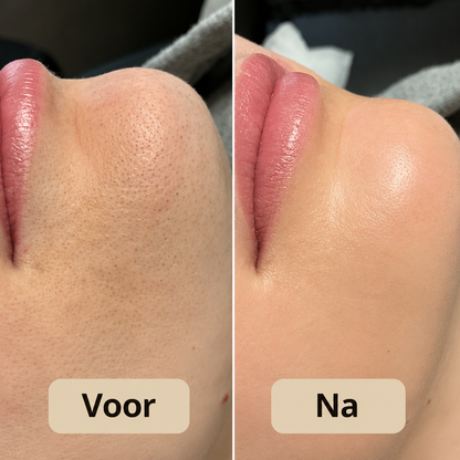 Peel Shot - Verwijdert onzuiverheden en laat uw huid stralen